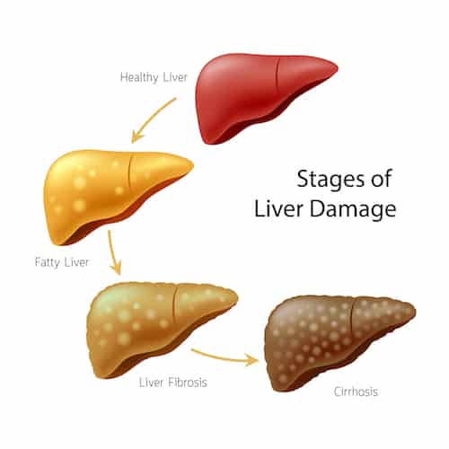 Signs Of Nonalcoholic Fatty Liver Disease 2 shutterstock 1071451652 copy