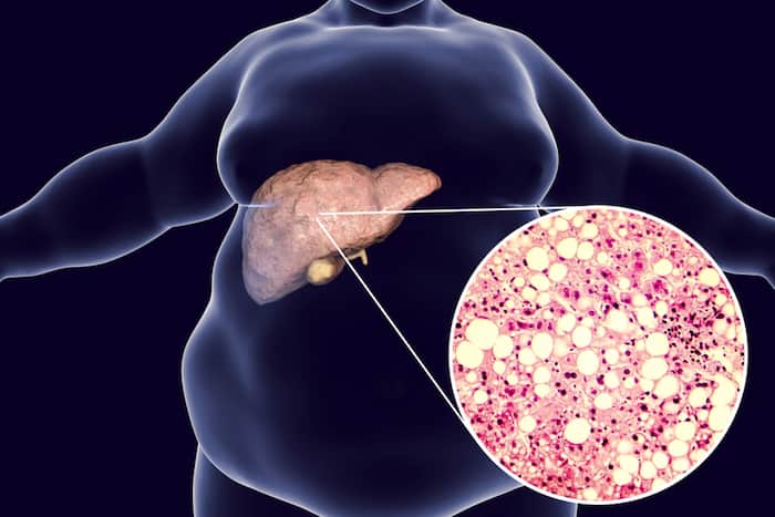 Signs Of Nonalcoholic Fatty Liver Disease 1 shutterstock 781186009 copy