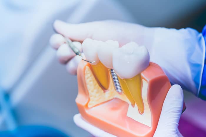 8 Things To Consider Before Getting Dental Implants 1 AdobeStock 294176655
