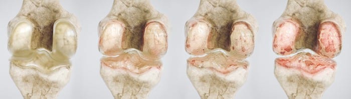 osteoarthritis of the knee in four stages - high degree of detail -- 3D Rendering