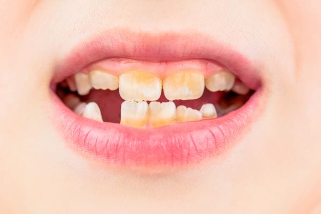 7 Potential Health Effects Of Discolored Teeth 1 AdobeStock 440725786