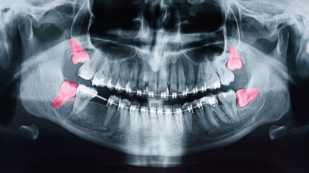 9 Care Tips For Wisdom Teeth 1 AdobeStock 223913289