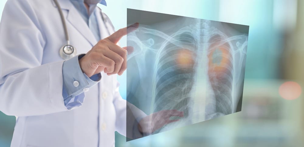 AI Accurately Identifies Normal and Abnormal Chest X-rays
