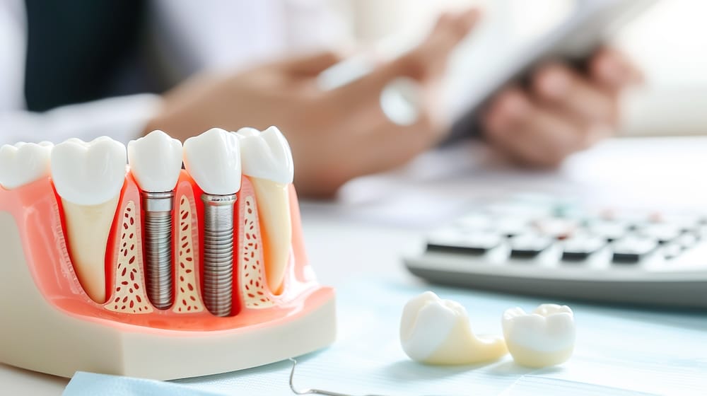 Breaking Down The Cost Of Dental Implants: What Are You Paying For? 1 AdobeStock 769778830