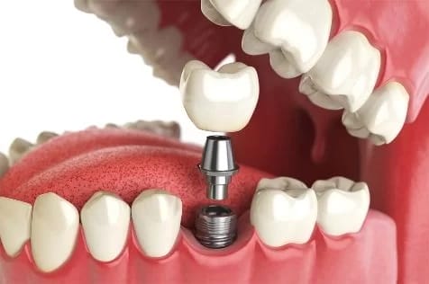 Dental Implants in Perth: Exploring the Connection Between Oral Health and Overall Health 1 Dental Implants Cost in Sydney